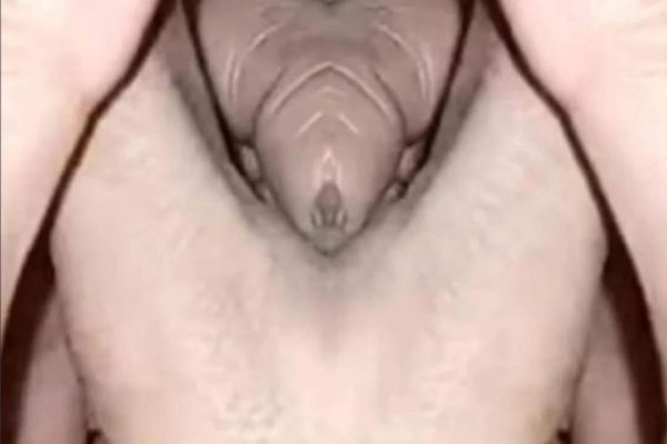 SKIN blackhead treatment