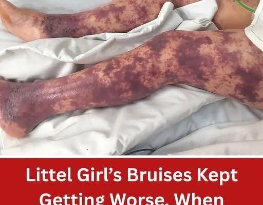 Little Girl’s Bruises Kept Getting Worse. When Mom Found Out The Truth, It Was Too Late…!