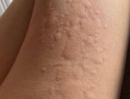 Her Whole Body Was Itchy: What She Thought Was a Common Allergy Was Hiding Something More Serious