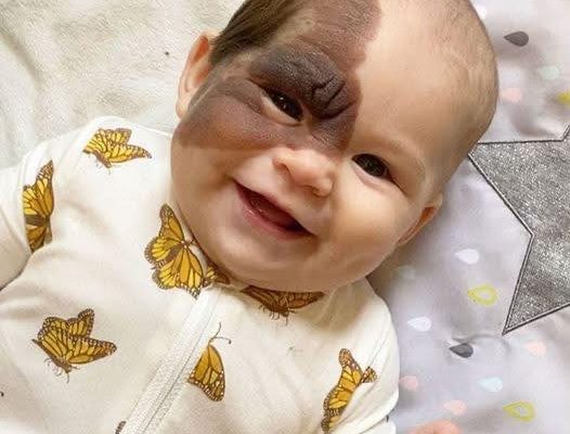 Parents’ Love Drives Them to Remove Daughter’s Birthmark