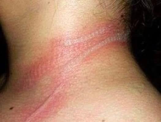 13-year-old girl left with horrific burns on her neck after using her cellphone while it was charging
