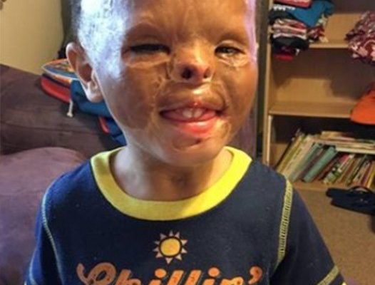 Foster baby is adopted 7 years after apartment fire left him with horrific burns