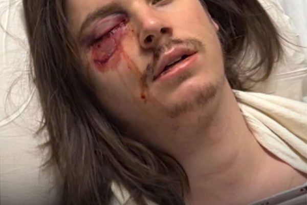Protester shot in the eye with rubber bullet during ‘No Kings Day’ rally in downtown Los Angeles
