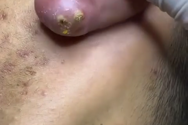 Big Cystic Acne Blackheads Extraction Blackheads & Milia, Whiteheads Removal Pimple Popping