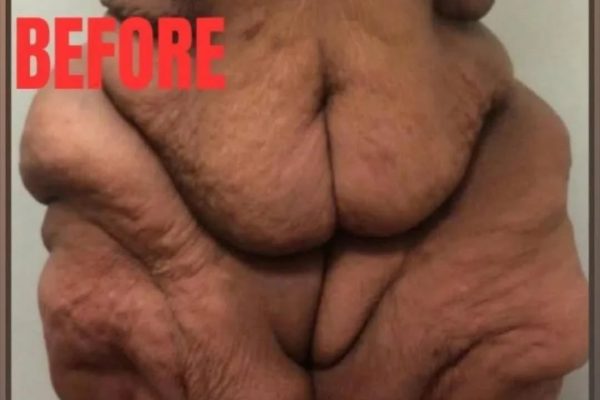 The world’s heaviest woman, who consumed a lot of milkshakes and weighed fifty stone, is no longer recognizable.
