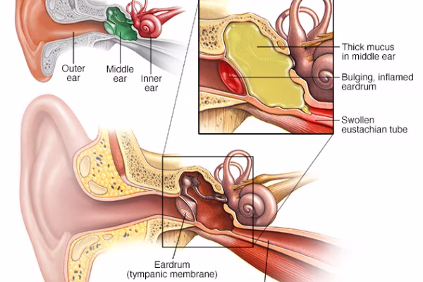 6 Symptoms of Ear Infection You Shouldn’t Ignore and Common Causes