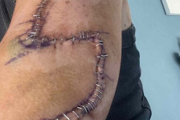 Mom Gets 77 Stitches in Arm After She Ignores a ‘Normal’ Mole