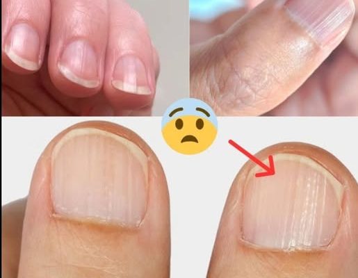 Doctor Reveals 7 Health Issues Hidden in Your Nails — What They Could Be Telling You